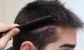 CORRECCIÓN DE CICATRICES Salud & Vida - Injerto Capilar